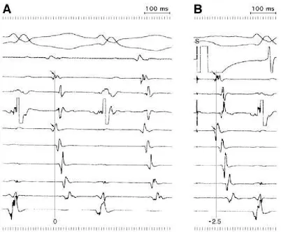 Figure 2. Pacemapping of accesory pathway. Atrial pacing (Panel B)to reproduce the atrialactivation sequence during orthodromic tachycardia (Panel A)