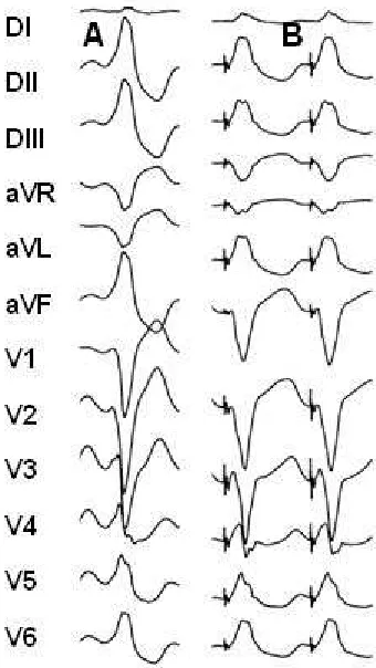 Figure  3.  VT  pacemapping.  Panel  A:  Left  bundle  branch  blockmorphology VT, inferior axis and R wave transition in V4