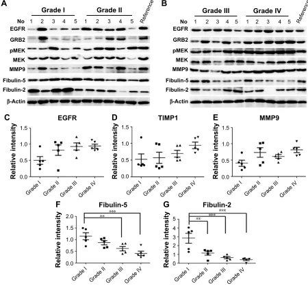 Figure 5 Western blot validations for five differential proteins.Notes: (A and B) The results are shown as representative Western blot photograph of the five candidate biomarkers in different grades of astrocytoma