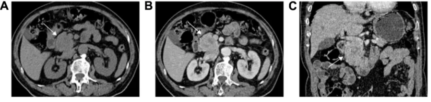 Figure 2 acinar cell carcinoma from the body of the pancreas in a 52-year-old male (A–C), and from the tail in a 49-year-old male (D, E).Notes: (A, D) axial enhanced computed tomography (cT) in arterial phase demonstrated the tumors (arrows) were relativel