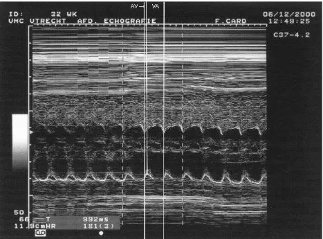Figure 5.1:  M-mode echocardiography of a SVT with a short VA interval. First white lineplaced on the peak excursion of the left atrium wall, second line placed on the peak excursion ofthe right ventricle wall, third line on the consecutive peak atrial wal
