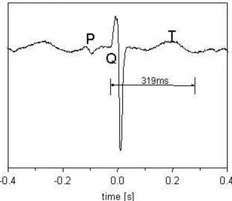 Figure 7: The QT interval is 319 ms, RR interval is 430 ms, QTc interval is 486 ms. 