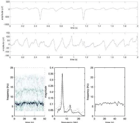 Figure 1: Frequency analysis of AF. Two seconds (out of a 60 second recording) of an ECGsignal from a patient with AF (upper panel), and the same interval after QRST cancellation(middle panel, amplitude scale is magnified five times)