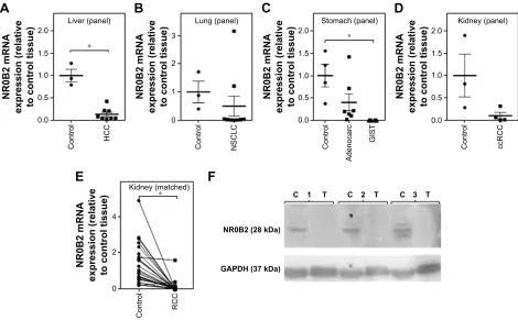Figure 1 nr0B2 expression in tumor tissue.commercially available cDna panelnsclc [stages i–iV], kidney and ccrcc [stages i, iii, and iV]) (Origene, rockville, MD, Usa), (rcc