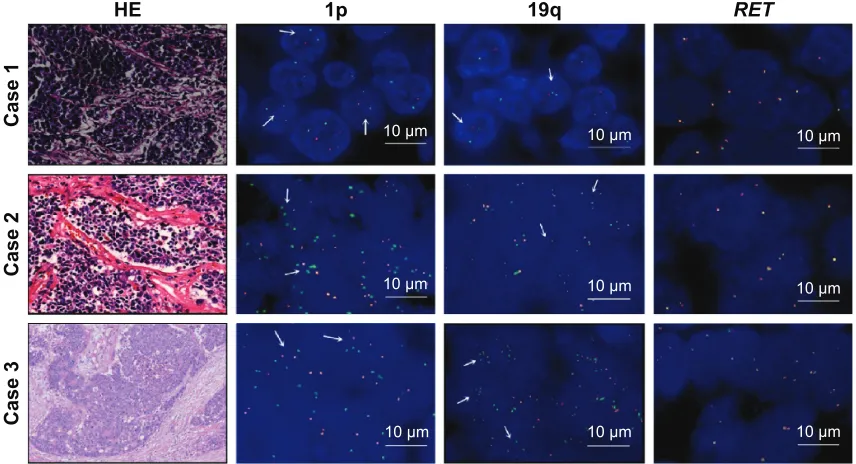 Figure 1 The results of 1p/19q codeletion and RET rearrangements.Notes: Only three patients had a 1p/19q codeletion and no patients had RET rearrangements