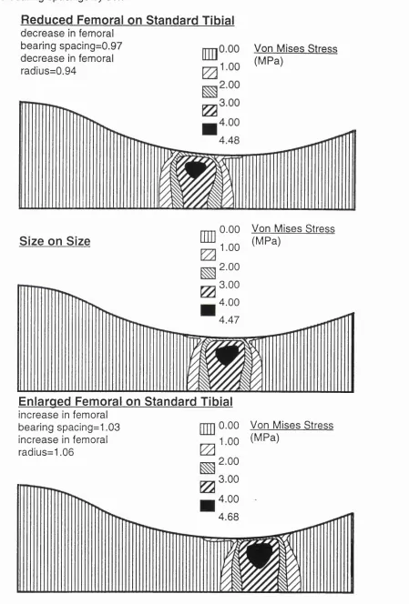 FIG .5 Contact stresses in the frontal plane for interchanged components where the outer tibial radius is 40mm