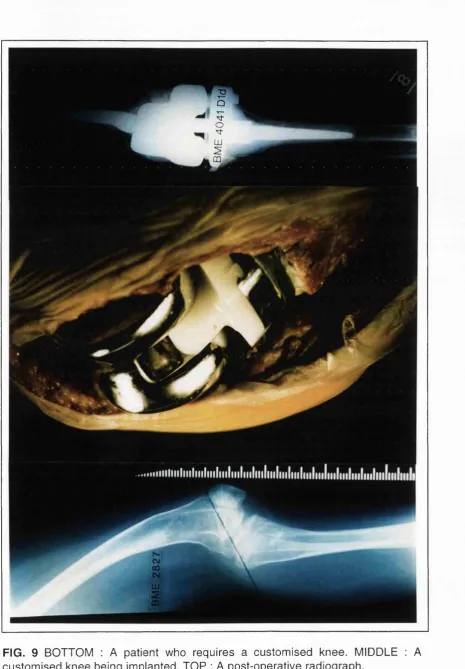 FIG. 9 BOTTOM : A patient who requires a customised knee. MIDDLE : A 