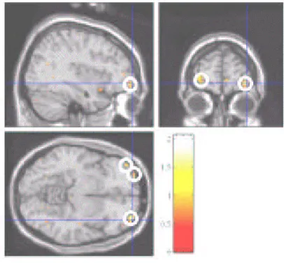 Figure 2.  Orbitofrontal Cortex activity using 2x6 >1x12 contrast.
