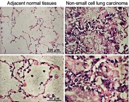 Figure 1. Microphotographs of hematoxylin-eosin-stained non-small cell lung carcinoma and adjacent normal tis-sues.