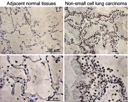 Figure 2. Representative microphotographs of immunohistochemical staining of TAK1 in non-small cell lung carci-noma and adjacent normal tissues.