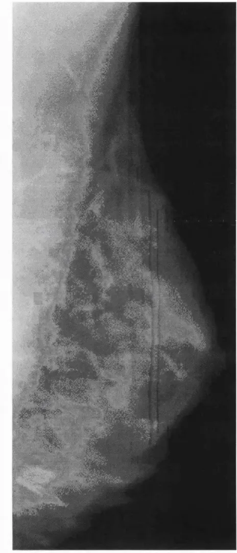 Figure 2: an example of a breast X-ray or mammogram