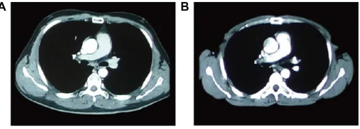 Figure 1 a complete response after six cycles of chemotherapy according to the contrast-enhanced chest computed tomography scan.Notes: Contrast-enhanced chest computed tomography scan showing a mass located in the hilum of the right lung (A)