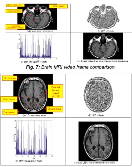 Fig. 7: Brain MRI video frame comparison 