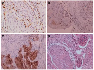 Figure 1 DePTOr expression in escc and adjacent tissues detected by immunohistochemistry.Notes: (A) normal adjacent tissue, sP ×100; (B) high differentiation, sP ×50; (C) moderate differentiation sP ×50; (D) poor differentiation, sP ×50