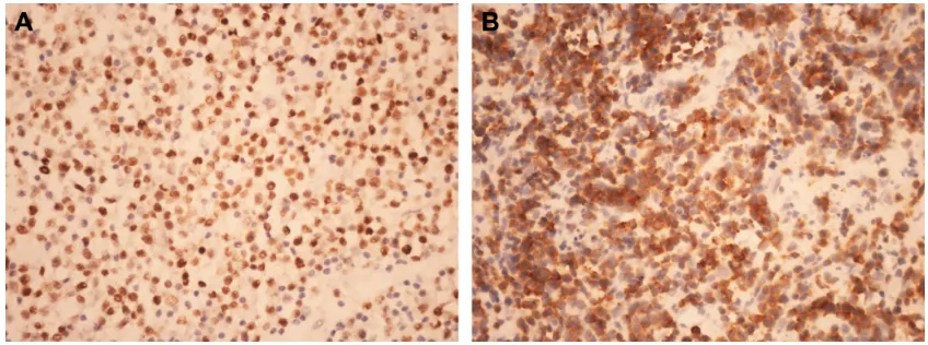 Figure S1 (A) MYc protein expression was exclusively brown nuclear (×400). (B) Bcl-2 protein expression was exclusively brown cytoplasm (×400).