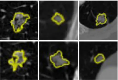 Figure 1 Various types of pulmonary nodules seen on computed tomography scan images. Lung nodules were highlighted by yellow color