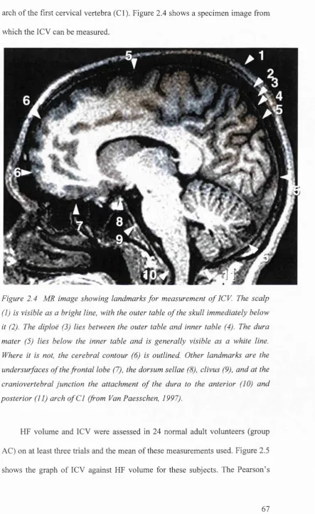 Figure 2.4 MR image showing landmarks fo r measurement o f ICV. The scalp 