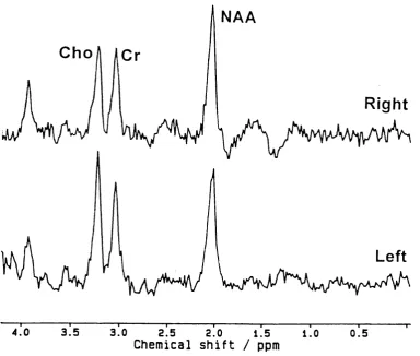 Figure 2.8 Normal (top) and abnormal (bottom) MR spectra. The bottom 