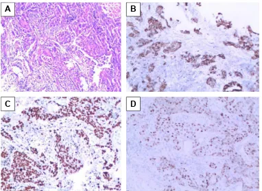 Figure 1 Fascin-1 expression in NSCLC tissues (SP ×100).Notes: (A) Nucleus staining of squamous cell carcinoma; (B) cytoplasm staining of squamous cell carcinoma; (C) nucleus staining of adenocarcinoma; (D) cytoplasm staining of adenocarcinoma.Abbreviation: NSCLC, non-small cell lung cancer.