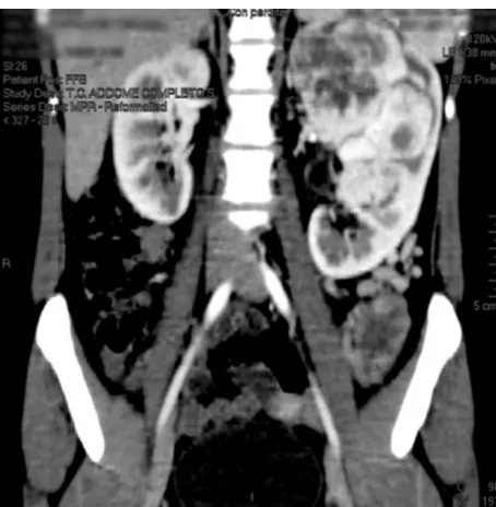 Figure 2 a computed tomography scan image showing the left renal mass with no vascular extension.