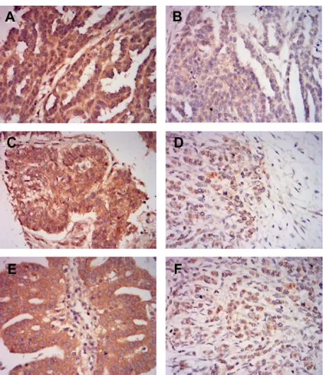 Figure 1 representative images of MLKL immunohistochemical staining in ovarian cancer tissues.Notes: (A) high MLKL expression in serous ovarian cancer tissue