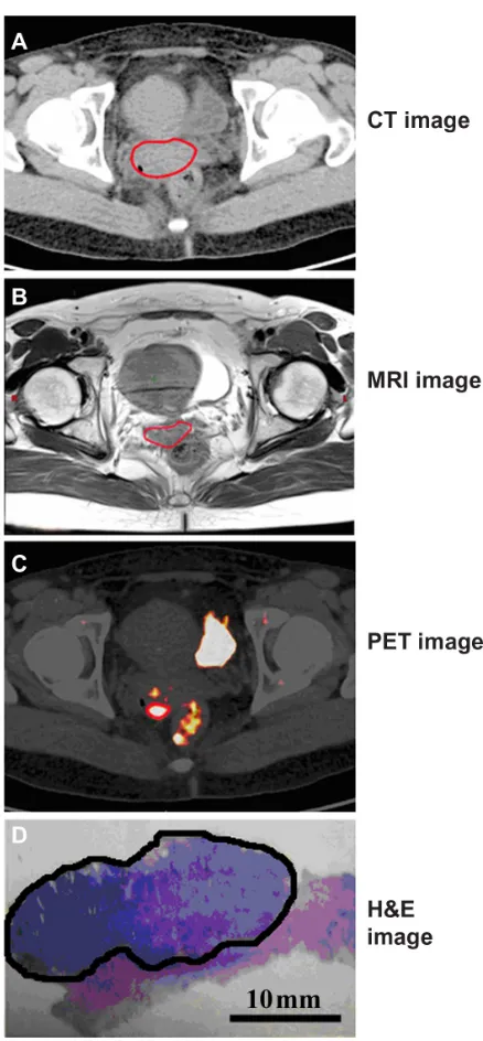 Figure 4 (A–C) Correlation of the different gross tumor volumes among imaging modalities and the surgical specimen