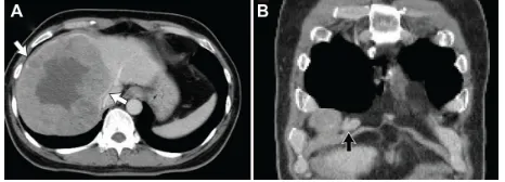 Figure 1 Computed tomography demonstrated a cirrhotic liver with a 14.5 cm hepatocellular carcinoma (white arrow) in the right lobe (A) and an enlarged lymph node in the right anterior cardiophrenic area (black arrow, B).