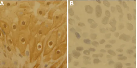 Figure 1 Immunohistochemical staining of PER1 protein (SP 400×). Expression of PER1 protein in adjacent noncancerous tissues is strongly positive (A) and expression of PER1 protein in oral squamous cell carcinoma is moderately or weakly positive (B).