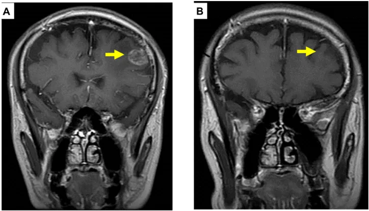 Figure 2 Pre (A) and post (B) treatment brain magnetic resonance imaging of metastatic tumor showing a complete response (arrows).
