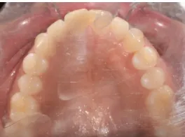 Figure 32: Incorrect choice and use of retractor                                      Figure 33: First molar not visible  