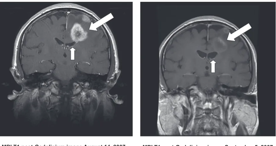 Figure 5 Mri scans showing a typical response of a recurrent GBM to bevacizumab. The image on the right shows the tumor-associated enhancement (large arrow) and accompanying compression of the ventricle by mass effect (small arrow)