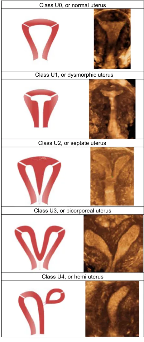 Figure 1 Classification of main uterine anomalies.Notes: Schematic representation (left); three-dimensional sonographic images (right)