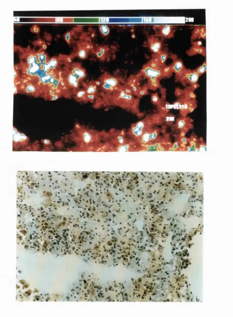 Figure 7.6 Lung sections 72 hours after intravenous injection of mTHPC . CCD images (Top ) and immunohistochemistry for macrophages on the same slide (Bottom)