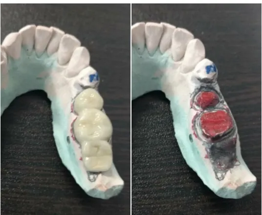 Figure 4. Clinical view after Cantilever bridge insertion 