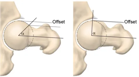 Figure 1 The α-angle is used to define the presence of cam morphology and, in this study, a threshold of >55° has been considered relevant.