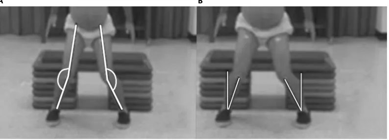 Figure 1 Frontal plane projection angles.Notes: (A) Method 1 established as the angulation exhibited by a line across ASIS, mid-patella, and the midpoint between both malleoli at the distal tibia