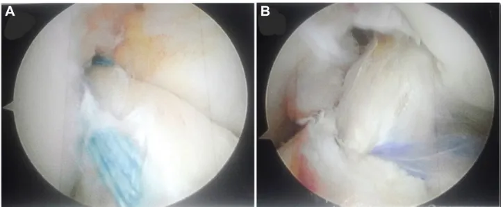 Figure 1 (A) Primary ACL repair using suture-based internal bracing system. (B) Single-socket, double-bundle ACL reconstruction using soft tissue quadriceps tendon autograft with aperture and extra-cortical fixation.Abbreviation: ACL, anterior cruciate ligament.