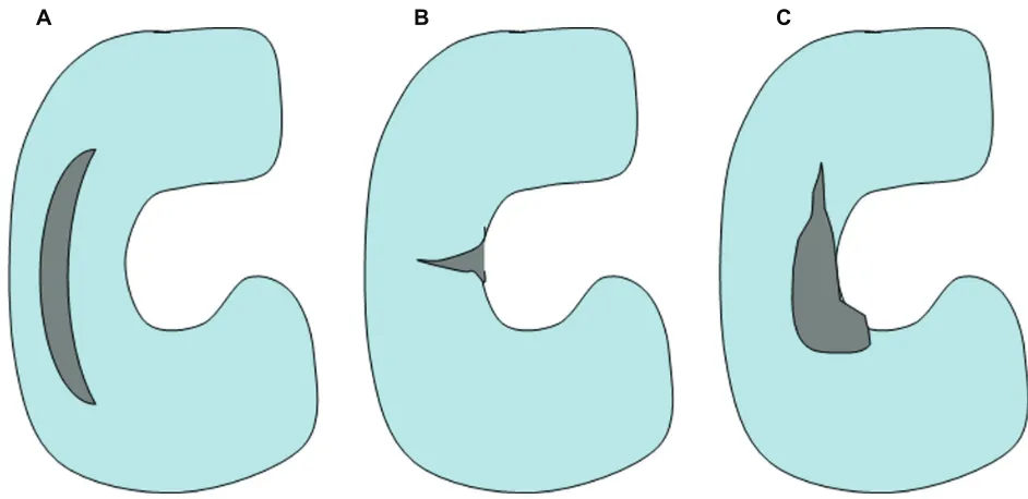 Figure 2 Schematic drawing, showing A) longitudinal B) radial, and C) complex meniscal tear.
