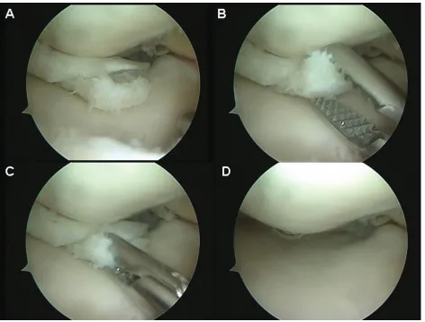 Figure 3 Partial resection of the medial meniscus for a complex lesion.