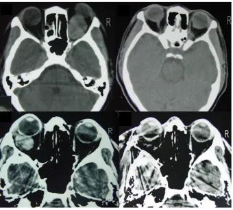 Figure 1 Some examples of orbital CT scans of our subjects showed a well-demarcated round lesion with same density as brain tissue and a mass effect on muscular structure.Abbreviation: CT, computed tomography.