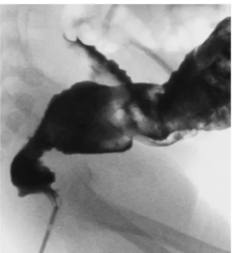 Figure 3 Contrast enema showing the transition zone in a Hirschsprung disease patient and abnormal rectosigmoid ratio.