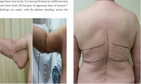 Figure 1 Brachioplasty.