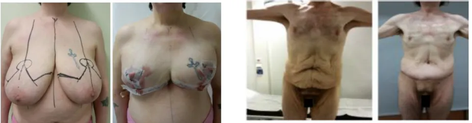 Figure 4 Abdominoplasty.