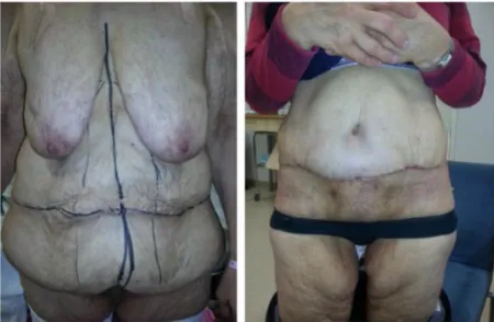 Figure 5 Panniculectomy.