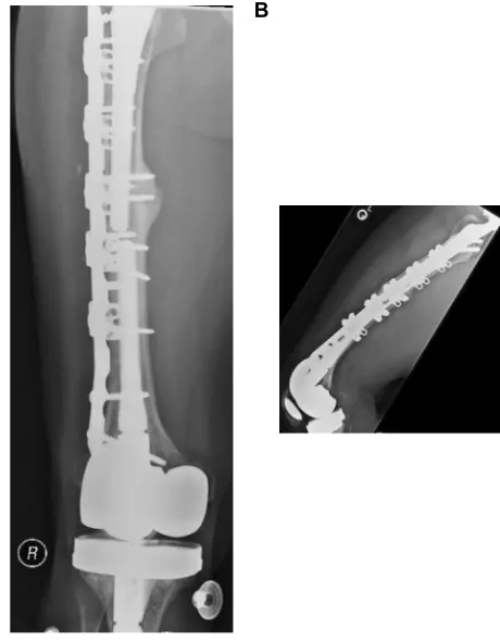 Figure 5 Anteroposterior (A, B) and lateral (C) radiographs of a distal periprosthetic femur fracture ﬁxed with a short retrograde nail and supplemented with a long laterallocking plate in a patient with osteoporotic bone