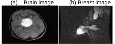 Fig. 3 . (a) and (b).  Preprocessed image of brain tumor and breast cancer 