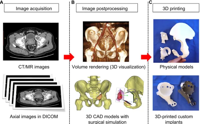 Figure 3 Summary of the steps in patient-specific orthopedics in a patient with low-grade chondrosarcoma involving the anterior acetabulum of pelvis and a partial acetabular tumor resection and reconstruction with a 3D-printed custom implant was planned
