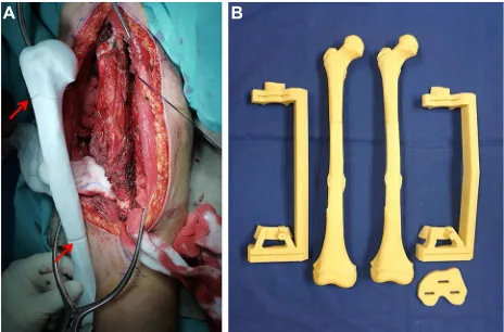 Figure 4 (A) This image shows surgical exposure in a patient with humeral shaft for a joint-saving tumor resection in a 9-year-old patient with femur osteosarcoma.Abbreviations: bone sarcoma undergoing intercalary tumor resection