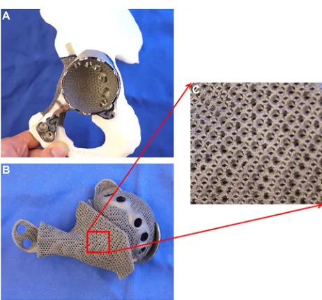 Figure 5 (A) and (B) The figures show a 3D-printed custom implant for acetabular reconstruction in the patient with low-grade chondrosarcoma