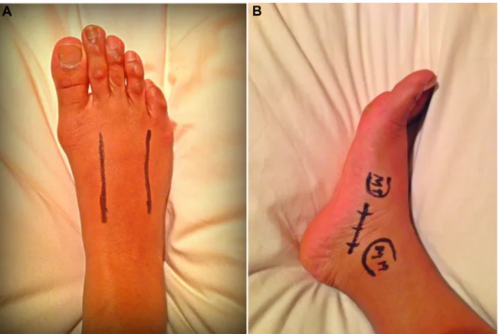 Figure 8 incision lines.